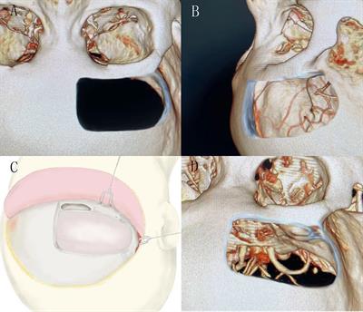 Unilateral Subfrontal Approach for Giant Tuberculum Sellae Meningioma: Single Center Experience and Review of the Literature